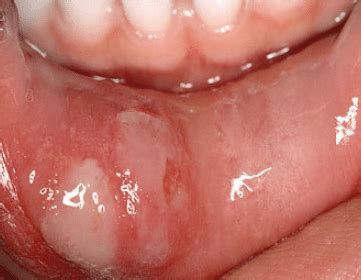 How long did it take to get here? Sore inside Mouth Causes, Pictures, How to get rid of ...