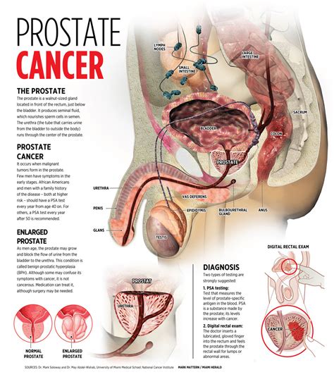 In stage iii, the cancer has started to spread and is no longer only affecting the prostate gland. Top 10 Most Common Types of Cancer
