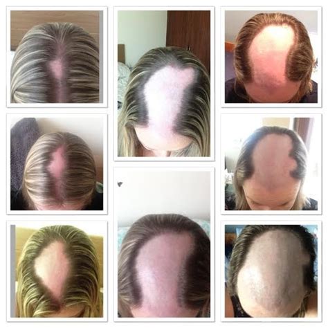 Laser hair therapy is one of the many options available to you when seeking solutions for your hair loss. What is Alopecia? - Hair Loss Blog