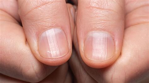 Ongles striés : causes et traitements