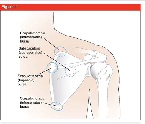 Over one third of total in a majority of cases, surgery is not necessary and the course of treatment can include physical therapy for scapular muscle strengthening and. Figure 1 from Snapping scapula syndrome: diagnosis and ...
