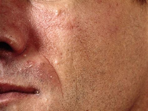 Spots appear that are lighter or darker than the surrounding skin, usually on the trunk or neck. Eczema Seborroicum (seborroisch eczeem)