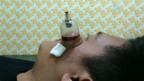 Cara menghilangkan jerawat dalam waktu sekejap memang sangat diinginkan oleh setiap orang yang mengalami masalah pada wajah mereka. CARA MENGOBATI JERAWAT | Bekam Jerawat Yogyakarta | PIMPLE ...