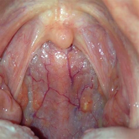 Auch die gürtelrose (= herpes zoster) wird durch vzv verursacht. Wieso habe ich gelbliche Flecken im Rachen (Gesundheit)