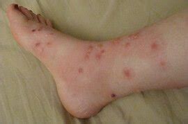 Sweat rashes are a very common condition and can occur at any time. Foot Rash: Causes, Symptoms & Treatment