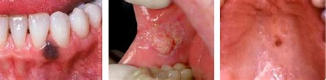 Whether it's to fight bad breath or just for good dental health, cleaning your tongue is important, dentists say. Oral Melanoma : Melanoma Education Foundation