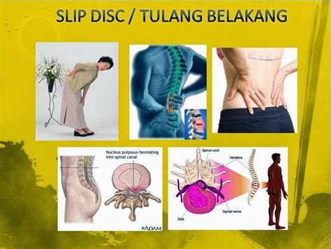 A slipped disc is when a soft cushion of tissue between the bones in your spine pushes out. Maisarah Shaklee | Pengedar Shaklee | Bandar Tun Hussein ...