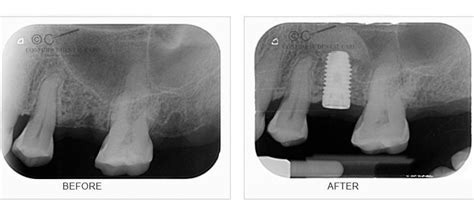 Our urgent care facilities in augusta, evans, and grovetown are operated by board certified er physicians. Dental Implant HSR Layout | Dental Implants Near Me ...