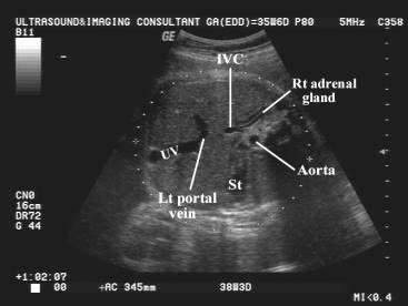 Measurements are taken such that the dates of the pregnancy can be confirmed or determined. Abdominal Circumference | Medical ultrasound, Medical ...