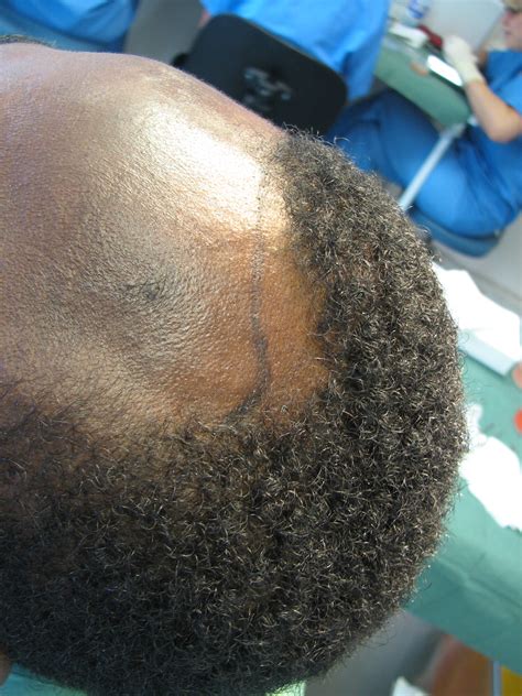 Best hair transplant procedure for black people: Afro hair transplant Westminster clinic