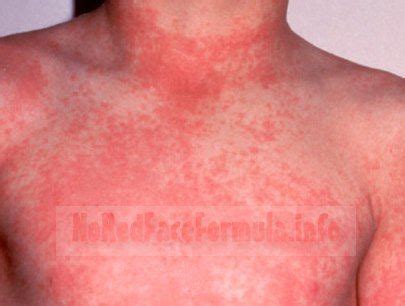 If you have a skin rash along with hives, itching, fever. Rash allergic reaction neck | Most severe alcohol rash on ...