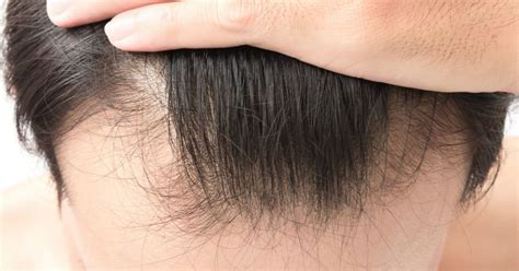 Avoid hairstyles which pull on your hair. Hair Loss Treatments for Guys Who Want to Keep Their ...