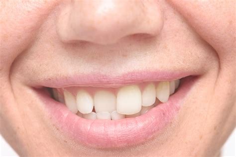 How to fix crooked teeth. Can Porcelain Veneers Fix Crooked Teeth? | Oakton, VA