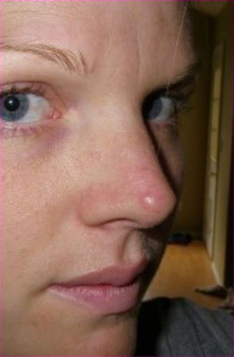 Ingrown hair there and your nose ingrown hairs tend to occur when a hair that's been removed through methods such as shaving, tweezing, or waxing grows back into your skin. cool Hairs growing on nose | Grow hair, Cool hairstyles, Nose