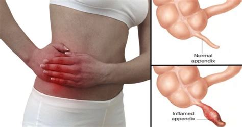 Webmd's appendix anatomy page provides detailed images, definitions, and information about the learn about its function, parts, location in the body, and conditions that affect the appendix, as well. 5 warning signs your appendix is about to burst - Doctorbabu