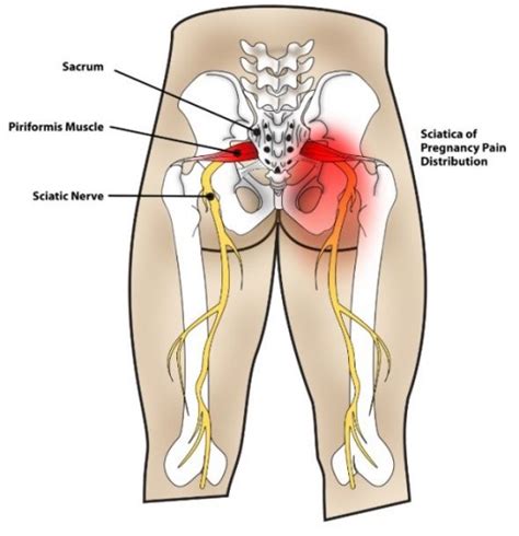 With a slipped disk in your lower back, you may have sharp pain in one part of the leg, hip, or buttocks you may also have weakness in certain muscles. Left hip muscle tear, right hip pain low back pain 3dpo ...