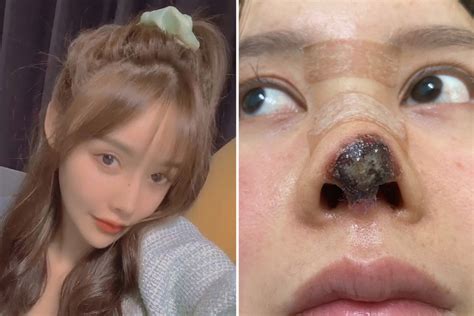 Not all celebs are happy with the results of their plastic surgery and other procedures. Pretty Chinese actress left with rotting deformed nose ...