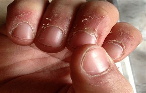The peeled fingertips sometimes develop fissures or cracks. Peeling Skin Around Nails or Under Finger and Toenails ...