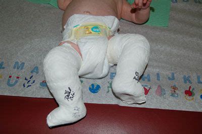 You can find all the information you need on our club foot treatment pricing page. Photos of Babies with a Clubfoot