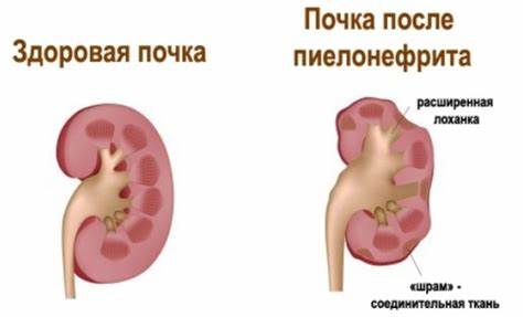 Воспаление почек диета Воспаление почек: причины, симптомы, лечение и диета Воспаление почек: причины, симптомы, лечение и диета Воспаление почек диета