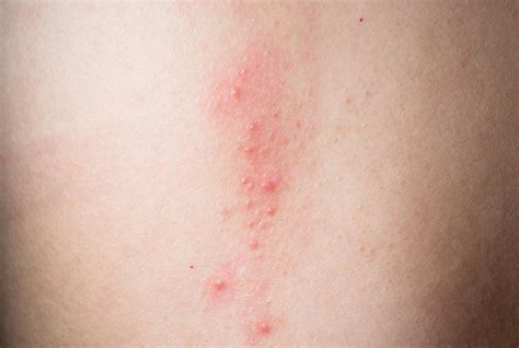 This is what i experienced and i might try the a zoster vaccine. Itchy chest: Causes and home remedies