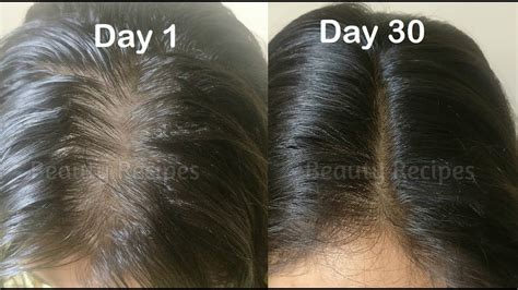 The oil is light and not greasy. Regrow New HAIR in 30 Days & Cure Baldness | Onion Juice ...