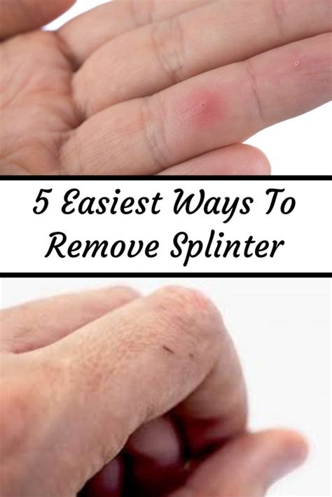 Then chop and cook the cactus for further recipes. 5 Easy Methods To Remove a Splinter at Home | Splinter ...