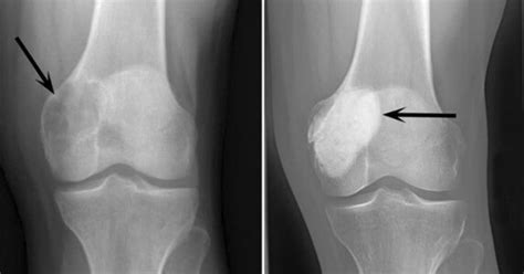 Rawatan sakit lutut kami mengambilkira punca sakit lutut, masalah urat saraf dari tulang belakang di pinggang ke lutut dan lutut ke betis. Punca Sakit Lutut Kiri : Ketahui 8 Punca Penyebab Sakit ...