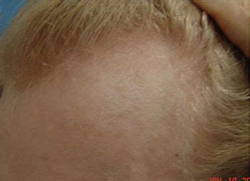 Roseville Hair Transplant Before and After Photos ...