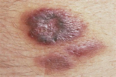 Bone, cartilage, fat, muscle, blood vessels. Kaposi's sarcoma - NHS.UK
