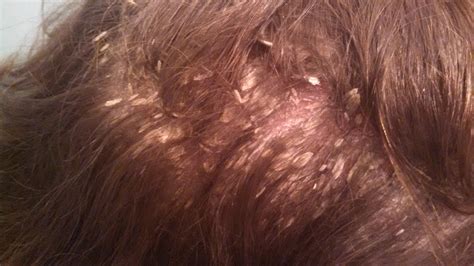 Pityriasis amiantacea is an eczematous condition of the scalp in which thick tenaciously adherent scale infiltrates and surrounds the base of a group of scalp hairs. Seborrheic Dermatitis : WTF