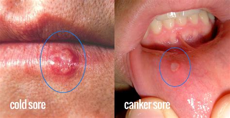 Does neosporin heal cold sores? Cold Sores Vs. Canker Sores. How to tell the difference ...