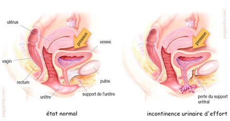 Stress urinary incontinence (sui), also known as effort incontinence, is due essentially to insufficient strength of the pelvic floor muscles. Incontinence urinaire féminine - Bandelettes - Centre ...