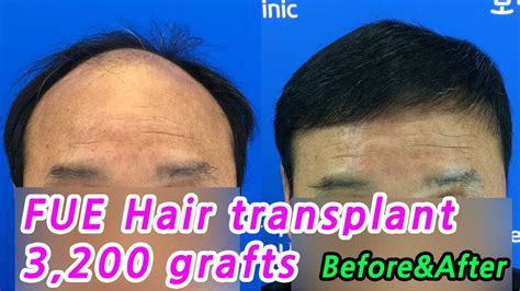 The best way to restore hair growth. FUE Hair Transplant in Korea (3,200 Grafts)_Before&After ...