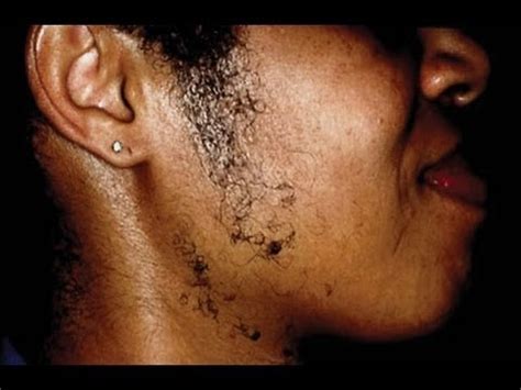 You tie a length of thread. Help w/ PCOS, Hirsutism & Acne in Black Women - YouTube
