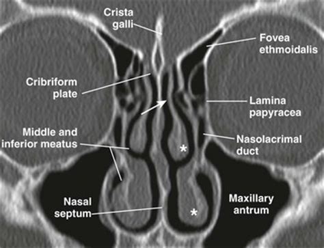 Learn about the anatomy of the skull bones and sutures as seen on ct images of the brain. Nose and Sinonasal Cavities | Radiology Key