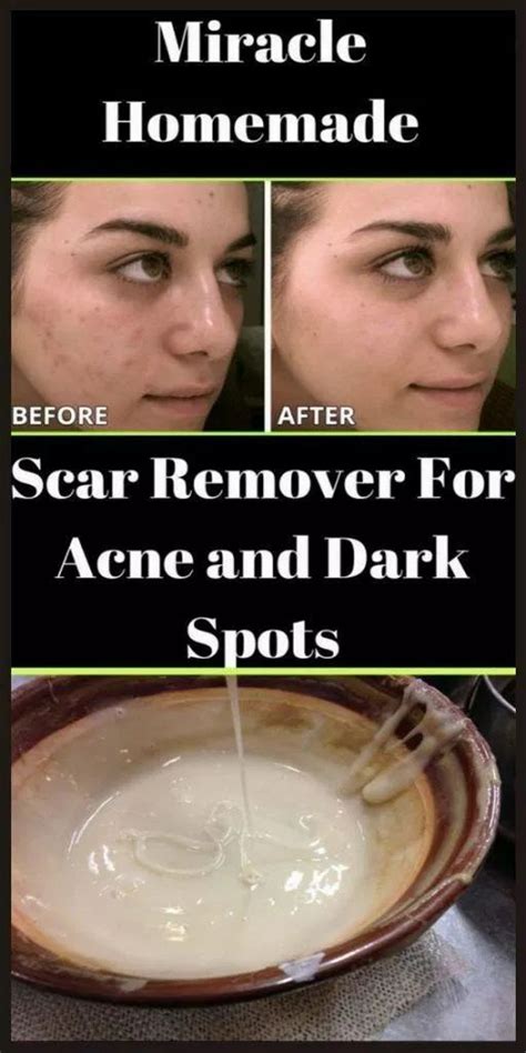 Vetiver root (vetivert) is a native plant in india that exhibit many hair and skin healing. Miracle Homemade Scar Remover For Acne And Dark Spots ...