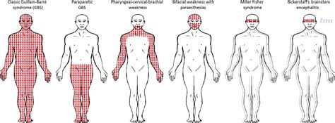 Pathogenesis, diagnosis, treatment and prognosis neurol. Mimics and chameleons in Guillain-Barré and Miller Fisher ...