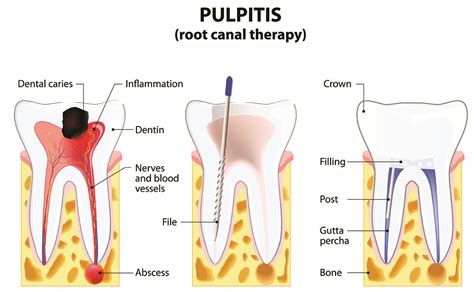 Root canal therapy has a high success rate at approximately 95%, and many treated teeth last a lifetime. Root Canal Treatments - Thomas Spray, DDS - Family Dental