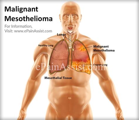 The median survival after malignant mesothelioma diagnosis is approximately 1 year. Known Causes Of Mesothelioma