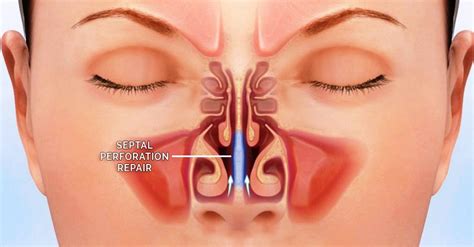 It can also occur as a result of an injury. Repair Septal Perforations - Pacific Eye & Ear Specialists