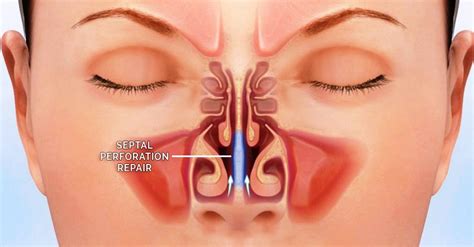 The symptoms are often worse on one side. Repair Septal Perforations - Pacific Eye & Ear Specialists