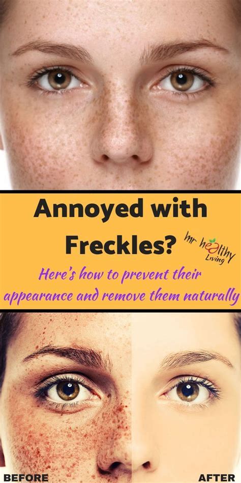 Maybe you would like to learn more about one of these? How to Get Rid of Freckles Naturally and Fast ? in 2020 ...