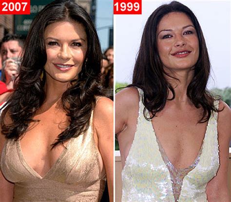 Celebrity Plastic Surgery Before & After (56 pics ...