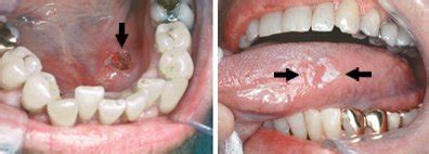 Knowing what mouth cancer look like can help you in diagnosing it at an earlier biopsying these cells is a great way of finding out whether they are cancerous or not. Oral Cancer Guide: Causes, Symptoms and Treatment Options