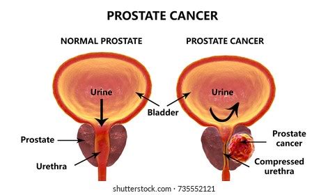 Pixel experience 9 pie rom + electra blue kernel. Prostate Gland Images, Stock Photos & Vectors | Shutterstock