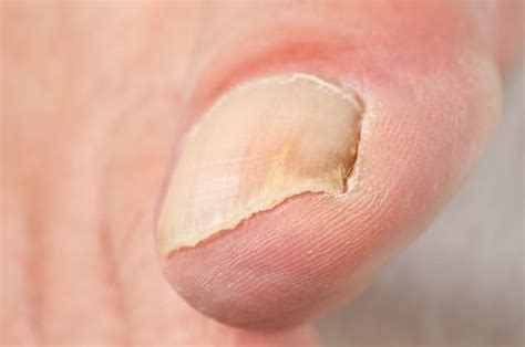 Melanoma is the most severe type of skin cancer. Getting Rid of Toenail Fungus | ThriftyFun