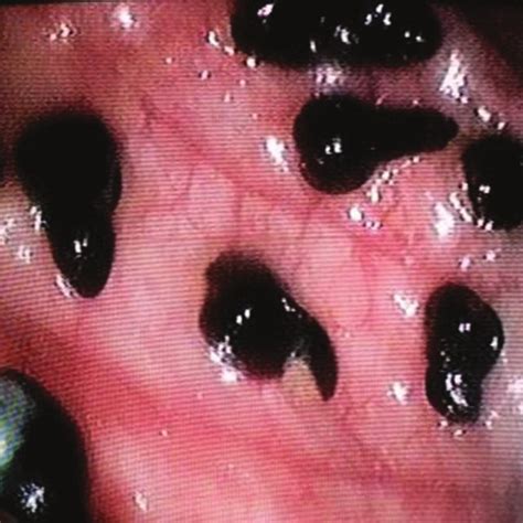 In most cases, the lead point is a malignant growth1. Gastrodiscoides hominis in cecum Figure 2: Gastrodiscoides ...