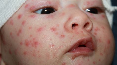 The babies would get the chickenpox viral dna from the mothers during pregnancy, the study says. Varicela: qué es, vacuna y síntomas (en niños y adultos)