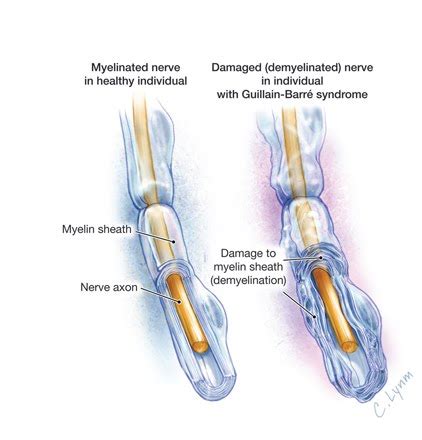 The main symptom is weakness of the muscles that are supplied by the affected nerves. GENETICA Y SEXOLOGIA INTEGRAL: SINDROME DE GUILLAIN BARRE